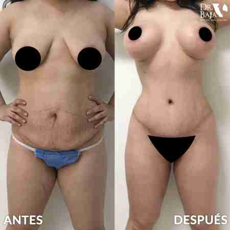 Breast Enlargement-18