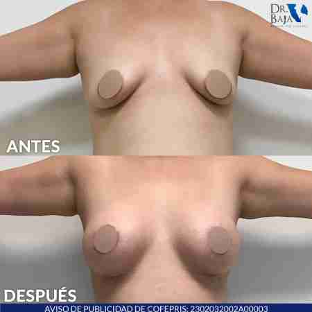 Breast Enlargement-19