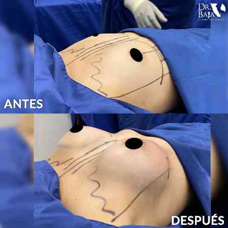 Breast Enlargement-20