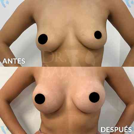 Breast Enlargement-24
