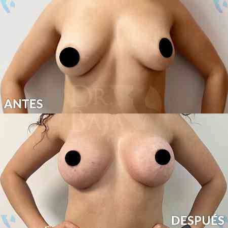 Breast Enlargement-25