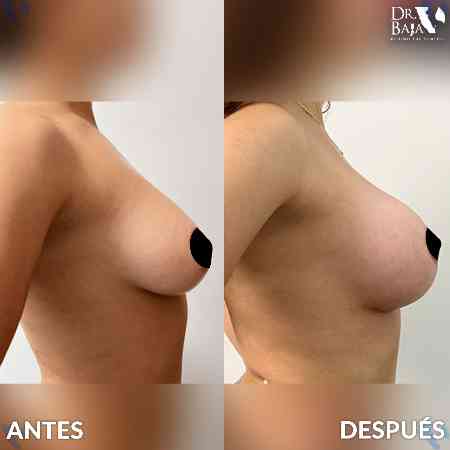 Breast Enlargement-26
