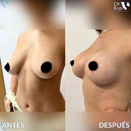 Breast Enlargement-28