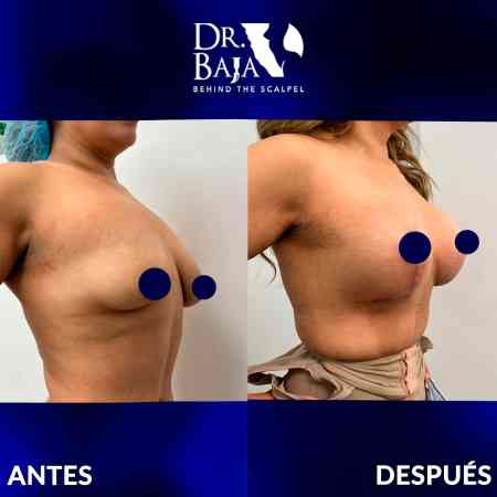 Breast Enlargement-37