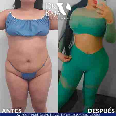 Breast Enlargement-43