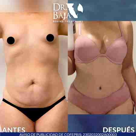 Breast Enlargement-44