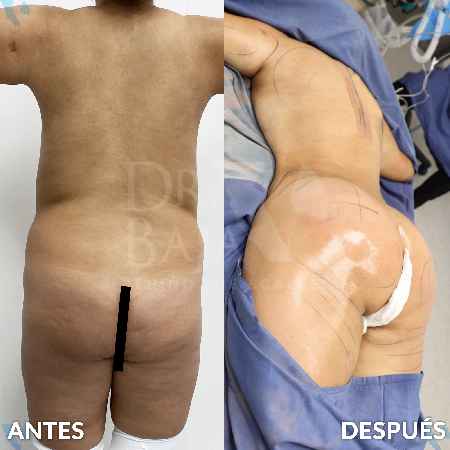 Transferencia de Grasa a Glúteos-1