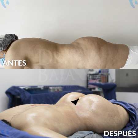 Brazilian Butt Lift-2