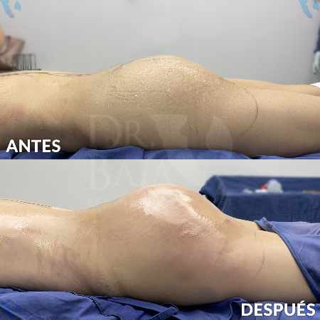 Transferencia de Grasa a Glúteos-9