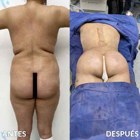 Transferencia de Grasa a Glúteos-10