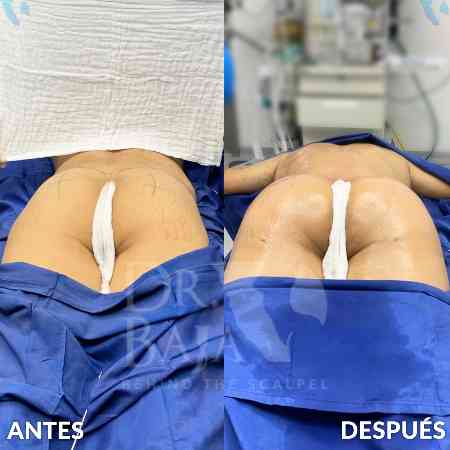 Transferencia de Grasa a Glúteos-11
