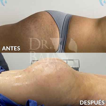 Transferencia de Grasa a Glúteos-13