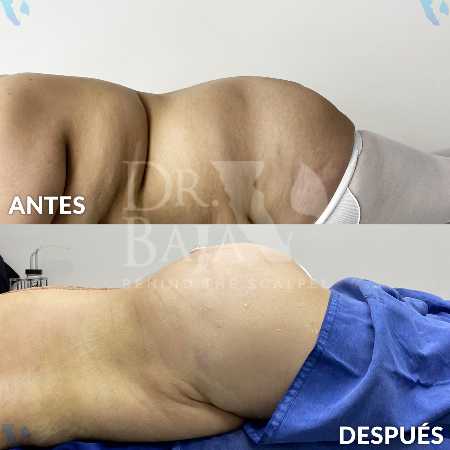 Transferencia de Grasa a Glúteos-14