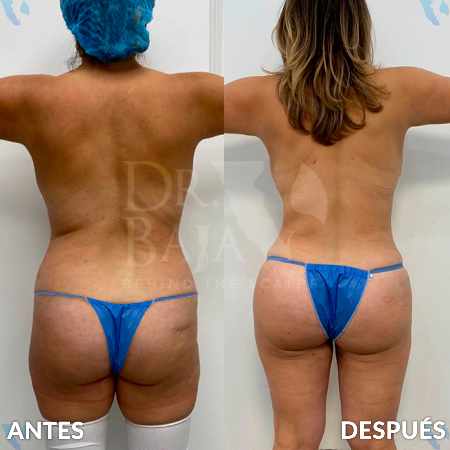 Brazilian Butt Lift-17