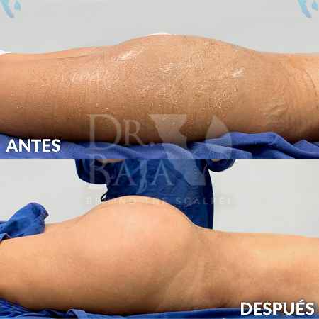 Brazilian Butt Lift-22