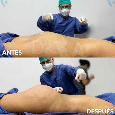 Brazilian Butt Lift-23