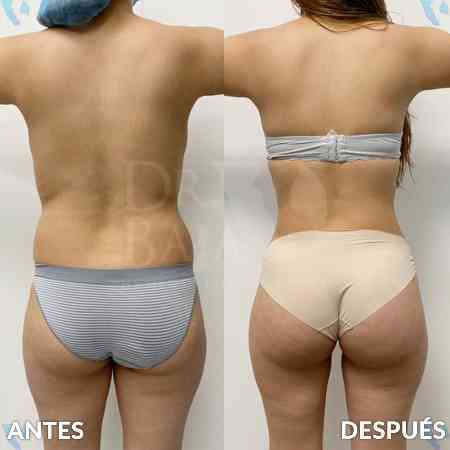 Brazilian Butt Lift-27