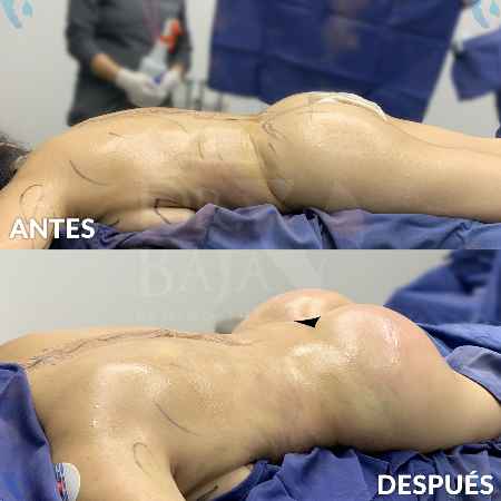 Brazilian Butt Lift-32