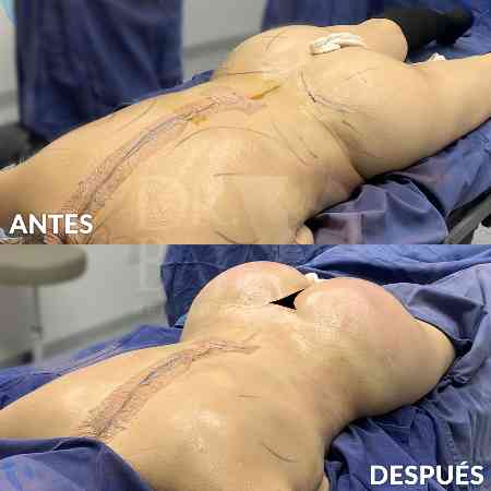 Transferencia de Grasa a Glúteos-33