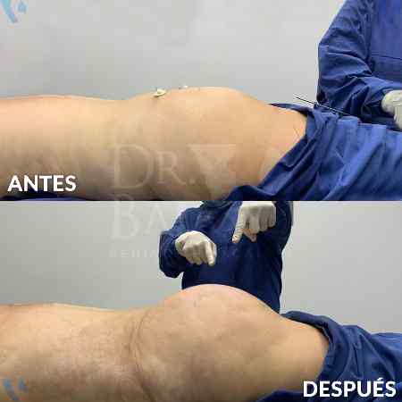 Brazilian Butt Lift-34