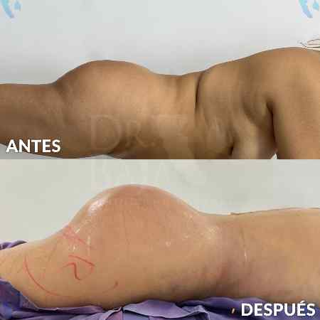 Brazilian Butt Lift-37