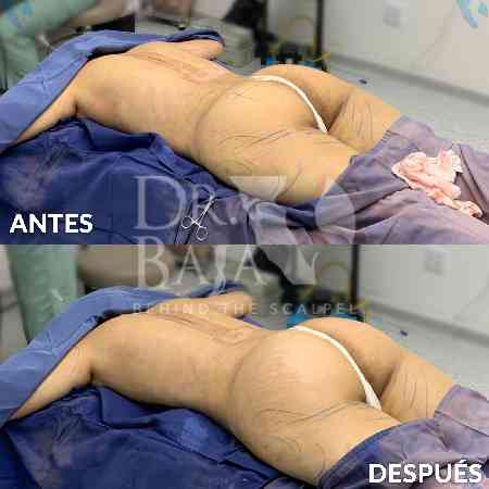 Brazilian Butt Lift-38