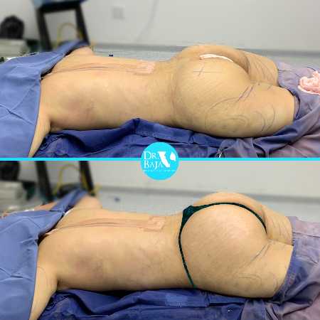 Brazilian Butt Lift-39