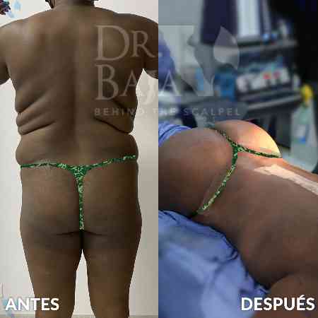 Transferencia de Grasa a Glúteos-40