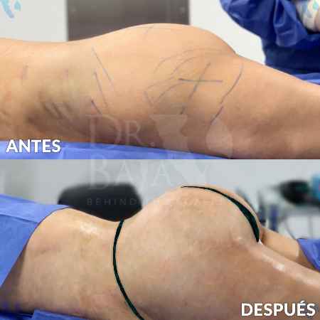 Brazilian Butt Lift-41