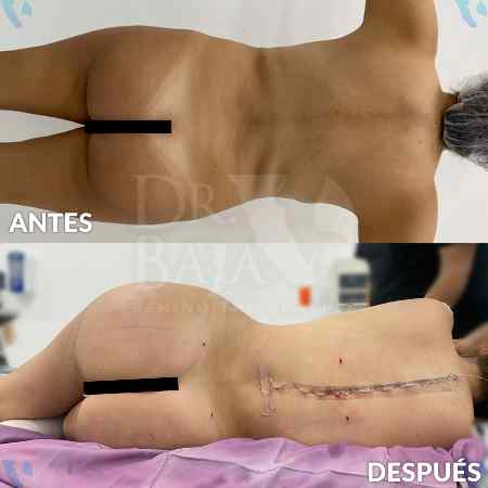 Brazilian Butt Lift-42