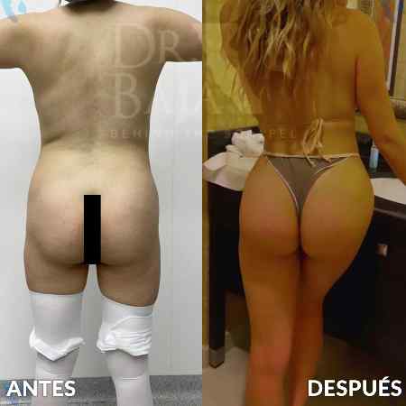 Brazilian Butt Lift-44