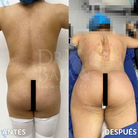 Brazilian Butt Lift-45