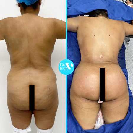 Transferencia de Grasa a Glúteos-46