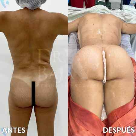 Brazilian Butt Lift-47