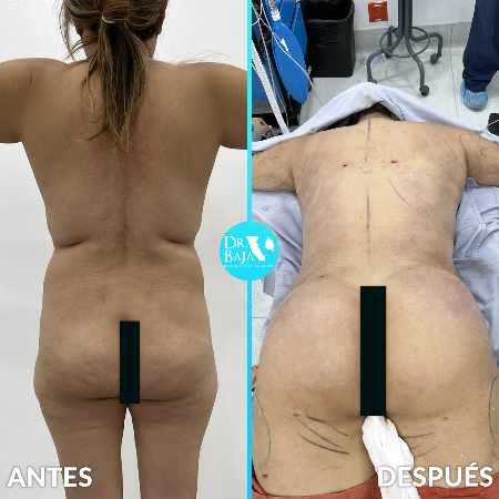 Brazilian Butt Lift-49