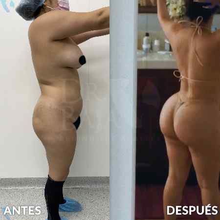 Transferencia de Grasa a Glúteos-50