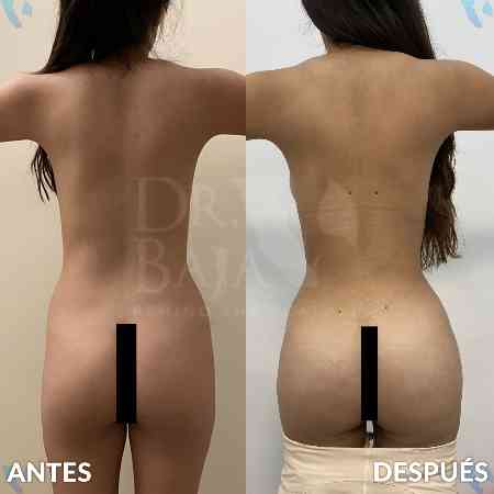 Brazilian Butt Lift-52