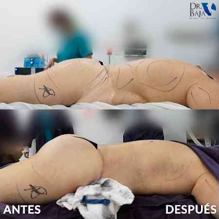 Transferencia de Grasa a Glúteos-56