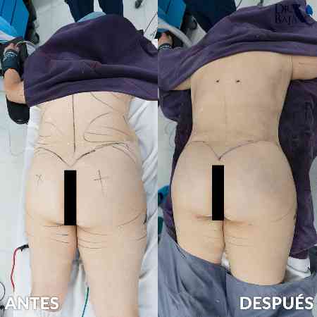 Brazilian Butt Lift-57