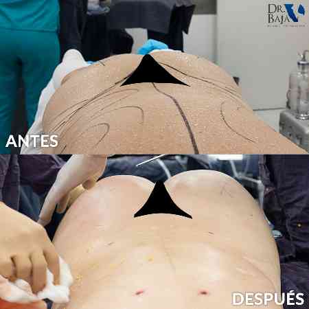 Transferencia de Grasa a Glúteos-58