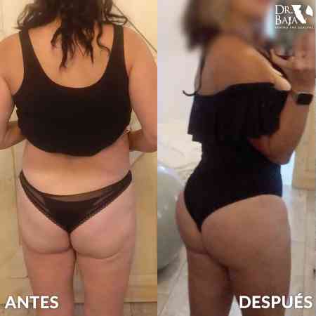 Brazilian Butt Lift-62