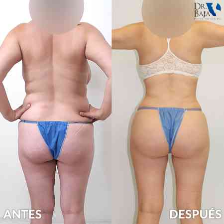 Transferencia de Grasa a Glúteos-63