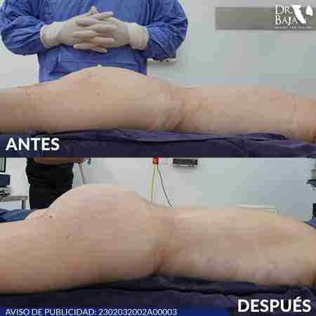 Transferencia de Grasa a Glúteos-65