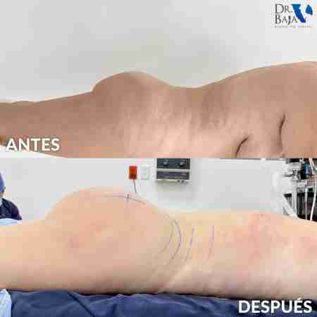 Transferencia de Grasa a Glúteos-66