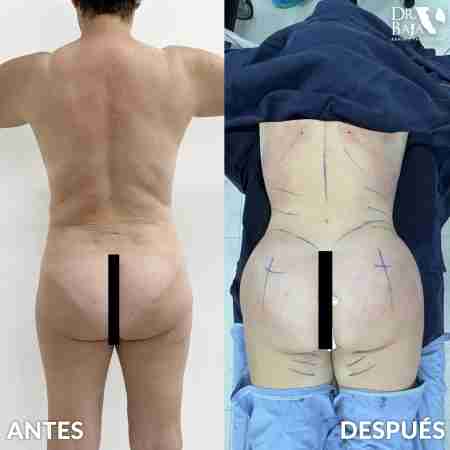 Transferencia de Grasa a Glúteos-67