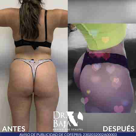 Transferencia de Grasa a Glúteos-69