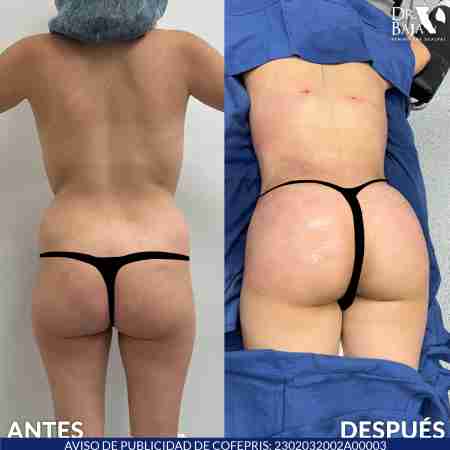 Transferencia de Grasa a Glúteos-72