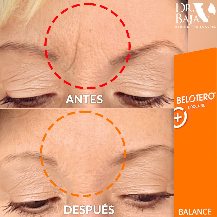 Belotero Hyaluronic Acid Facial Filler Dr. Baja