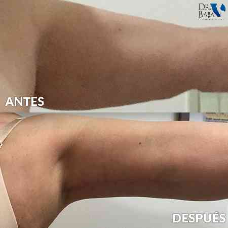 Braquioplastia-1