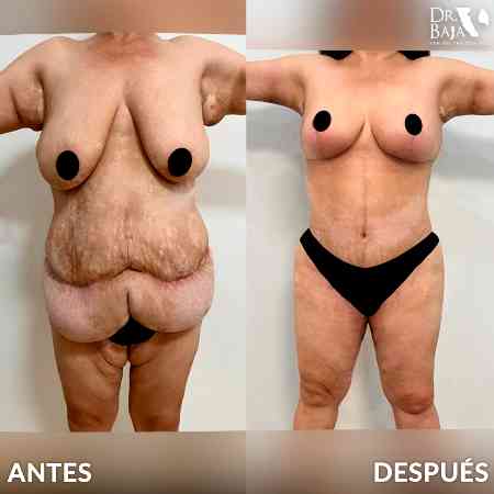 Braquioplastia-2
